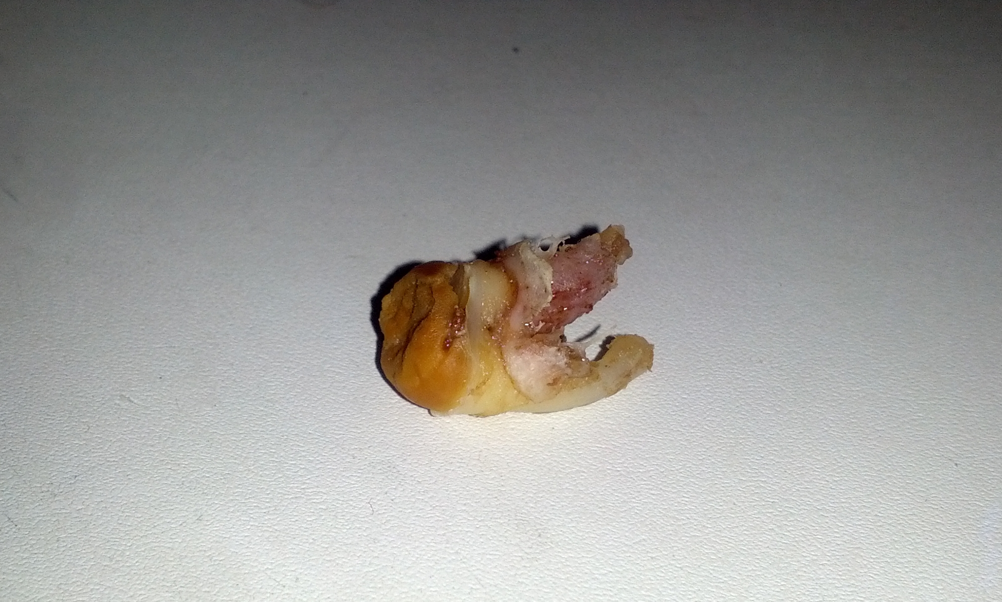disgustingcolawisdomtooth.jpg