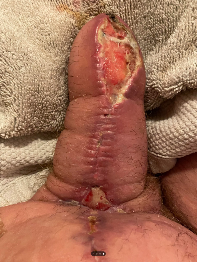 Dr_Rubin_leakingPus.jpg