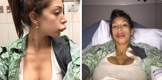 Farrah-Abraham-Botched-Lip-Injections.jpg