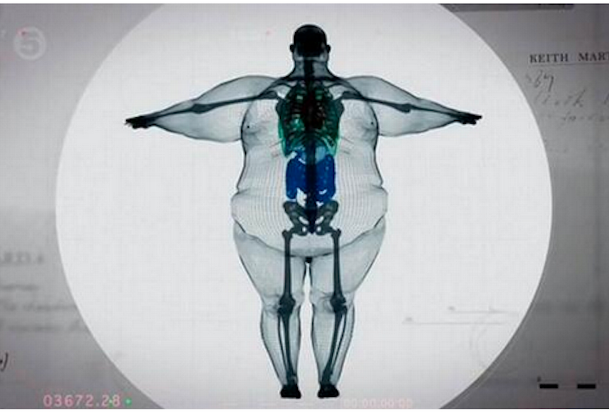FAT-MRI.png