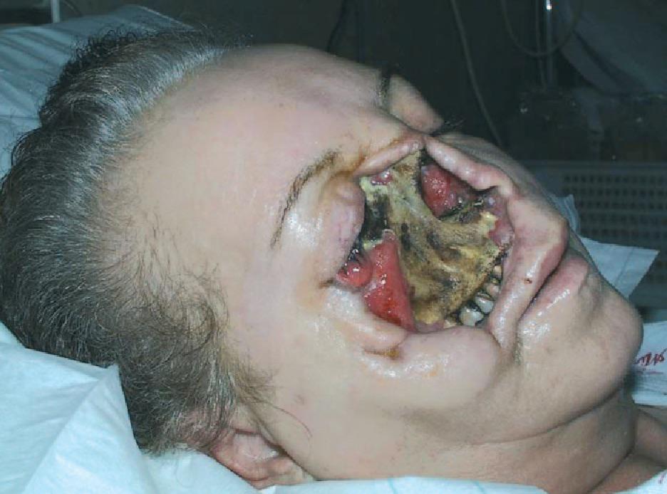 fungal infection.jpg