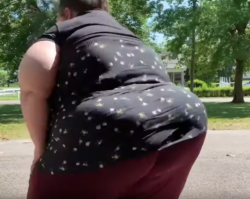 lymphedema-butt. - Copie.PNG