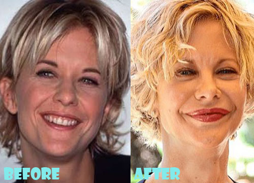 Meg-Ryan-Plastic-Surgery-Botox-and-Facelift.jpg