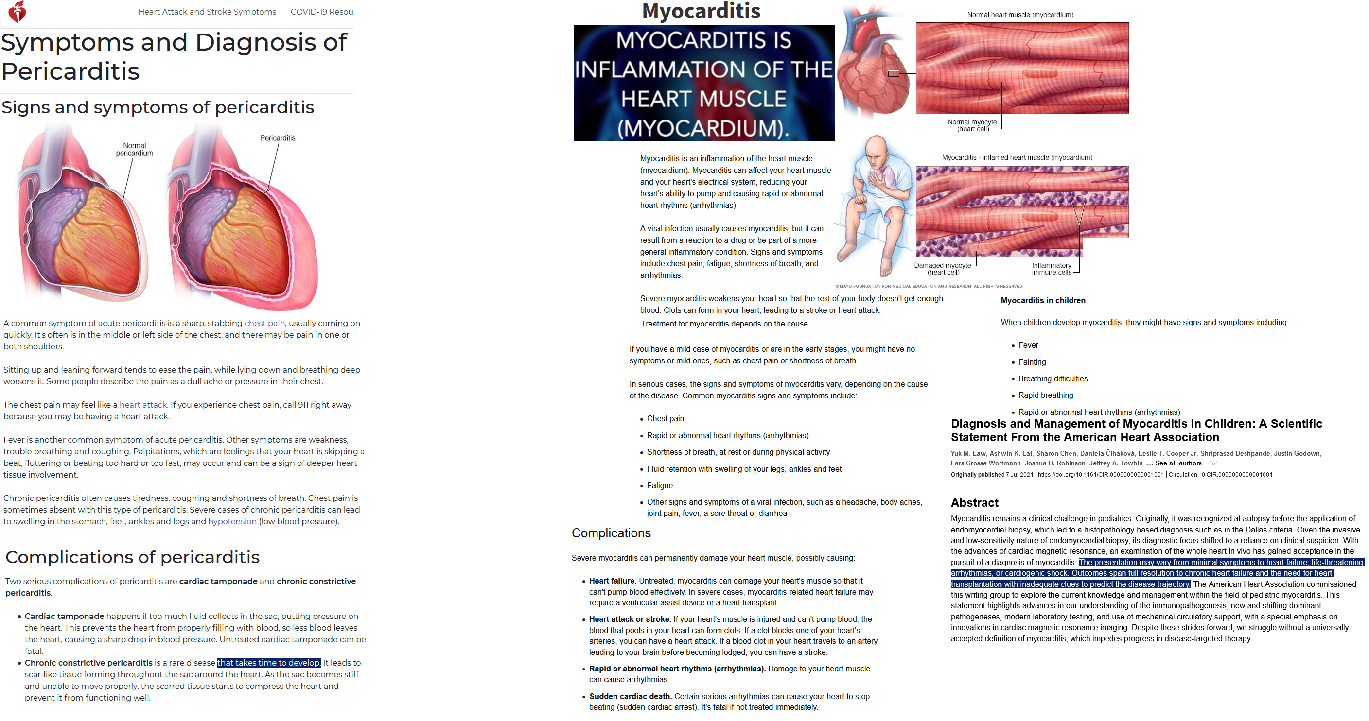 myocarditis pericarditis.png