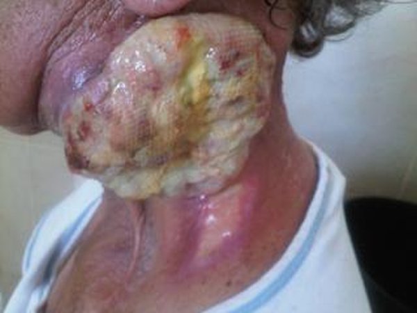radiationburns3.jpg
