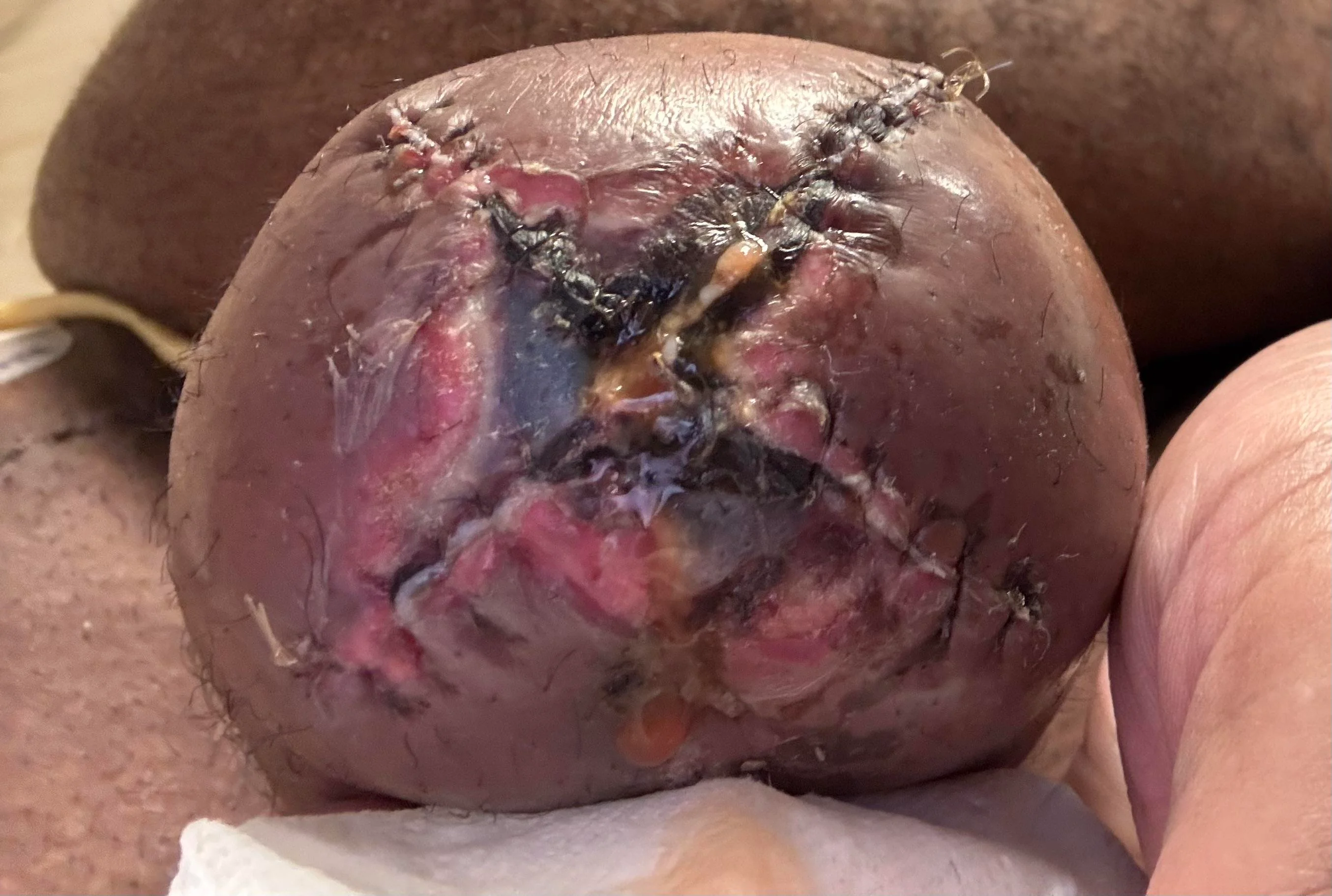 swelling-post-op-concerns-v0-beo26ch3qwoe1-webp.7100407