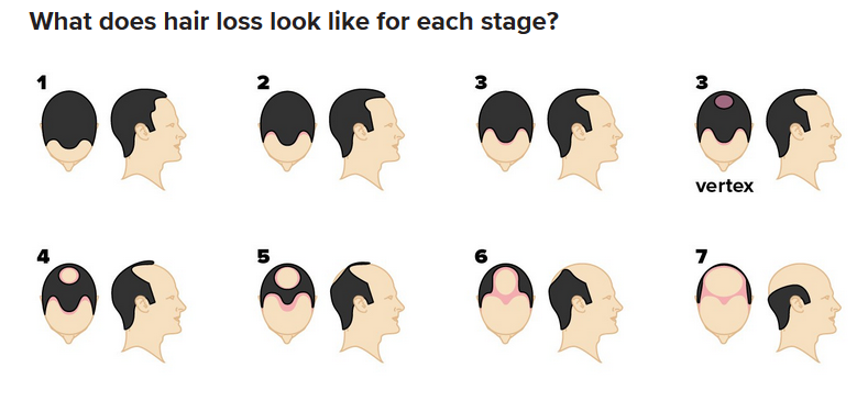 hair-loss-chart.png