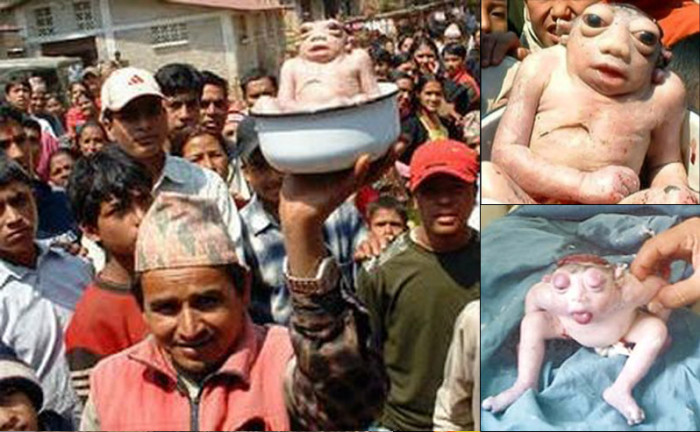 Anencephaly-700x432.jpg