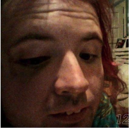 ADF_black_eye.jpg