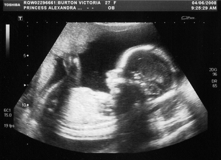 21-week-scan-picture-boy.png