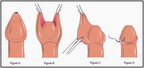 circumcision-diagram.jpg